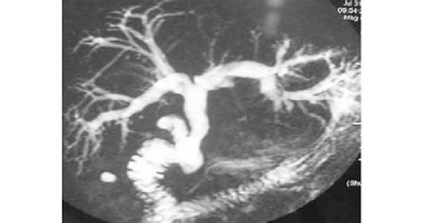 Image result for MRCP Biliary Tree