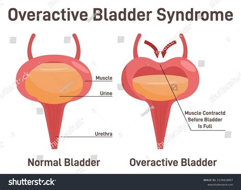 Distension Of Bladder