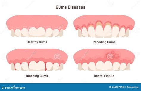 Human Gum Diseases Set. Gums Bleeding, Receding and Fistula Stock Vector - Illustration of oral ...