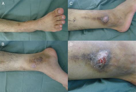 Osteomyelitis After TightRope® Fixation of the Ankle Syndesmosis: A ...