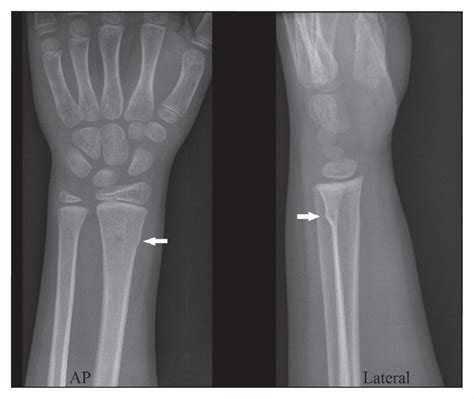 Buckle fractures of the distal radius in children | CMAJ