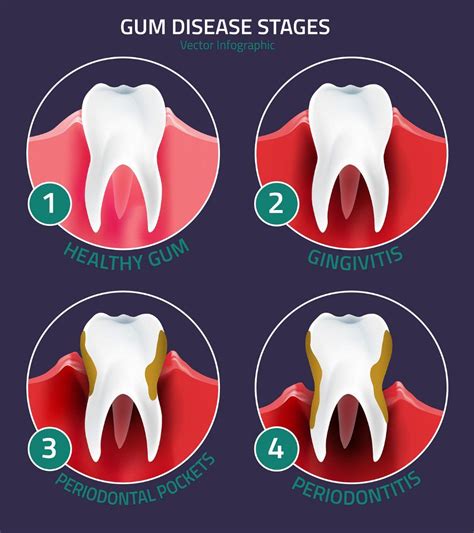 Family Dentistry: Detecting the Early Warning Signs of Gum Disease