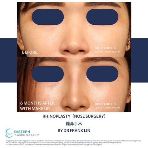 Low Nose Bridge Melbourne | Expert Asian Plastic Surgery