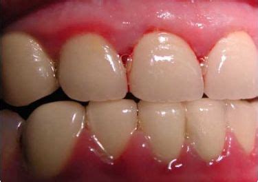 牙周病-关于牙龈出血你应该知道的-口腔百科-云看牙