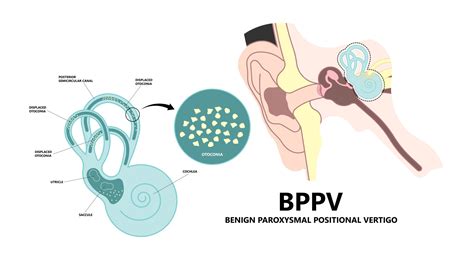よくある疾患シリーズ 〜良性発作性頭位めまい症（BPPV）〜 - やまもとよりそいクリニック