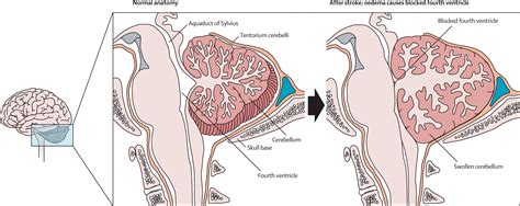 Diagnosis and initial management of cerebellar infarction - The Lancet Neurology