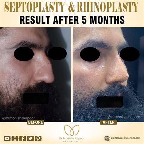 Transformation in Progress: Post-septorhinoplasty results after 5 ...