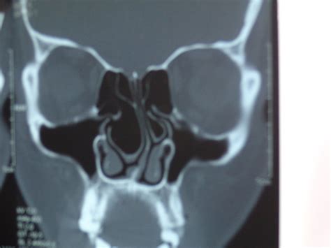 Nasal Obstruction - Concha Bullosa - Breathing Difficulty