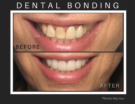 Bonding Tooth Procedure at Timothy Beck blog