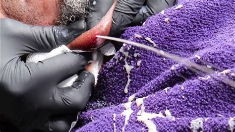 Largest Exploding Cyst 的图像结果