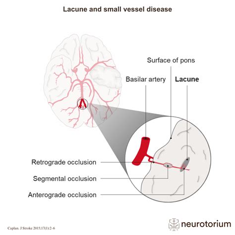 Small Vessel Disease