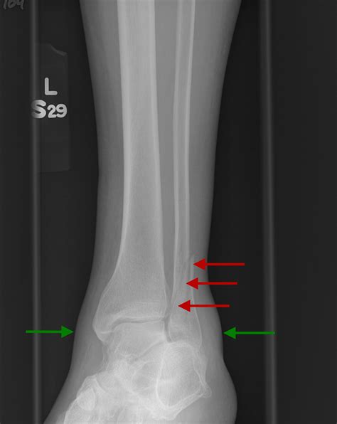 Proximal Fibula Fracture