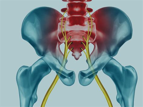 Sciatica: sciatic nerve compression- causes, symptoms and treatments