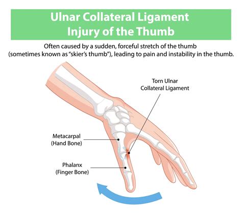 Ulnar Collateral Ligament Thumb Ligament Reattachment With Suture