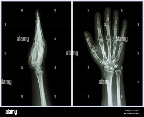 Wrist Anatomy Xray