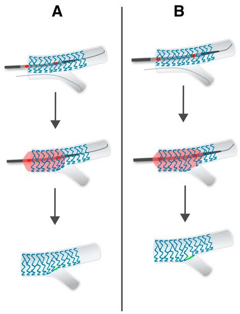 The Degree of Stent Apposition Measured by Stent Enhancement at the ...