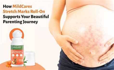 How MildCares Stretch Marks Roll-On Supports Your Beautiful Parenting ...