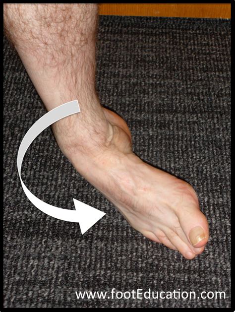 Ankle Sprains | OrthoPaedia