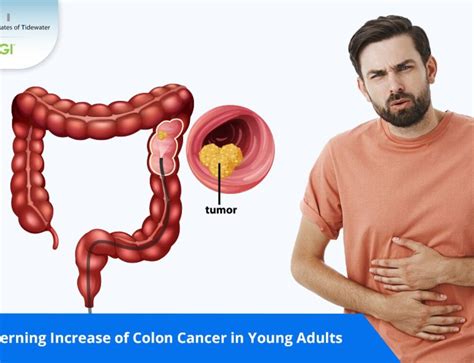 Colitis Vs. Cancer 的图像结果