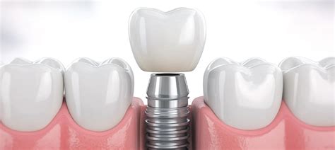 Image result for Different Types of Teeth Implants