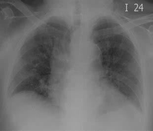 En radiografía de tórax, ¿a partir de qué medida se considera ...