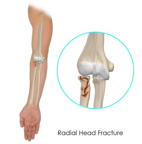 Radial Head Fractures Westchester NY | Elbow Joint Pain White Plains NY