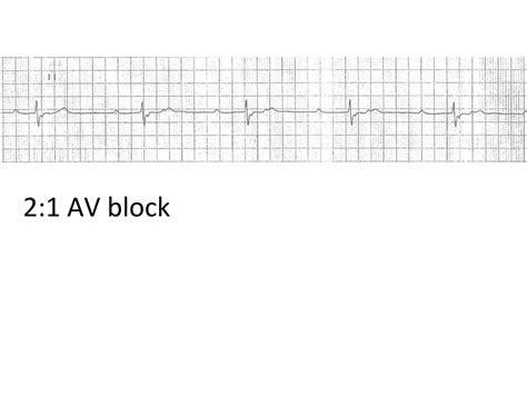 ECG Lecture: Sinus arrest, sinoatrial exit block, AV block and escape ...