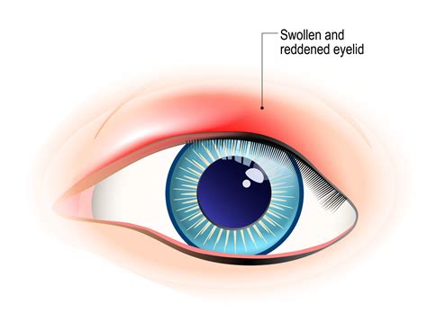 Eye Styes (Causes, Symptoms & 5 Ways to Get Rid of Them)