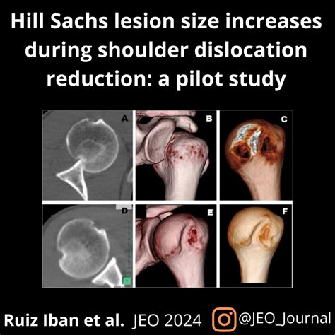 Hill-Sachs lesion size increased >25% in 4 out of 5 cases following a ...