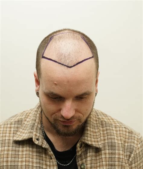 Normal Hair Density 的图像结果