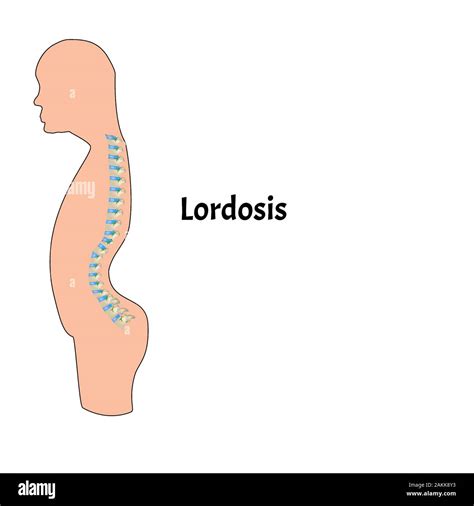 Lordosis Kyphosis