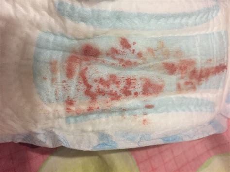Implantation Bleeding Photos : TMI. Implantation or just a late period? - On an average ...
