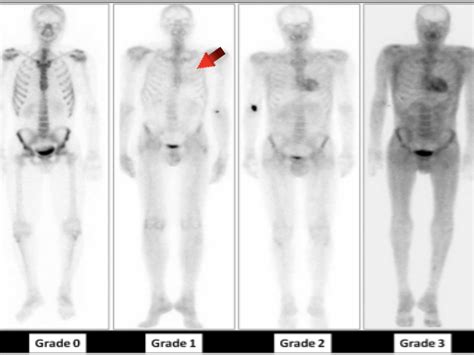 Nuklearmedizinische Bildgebung der kardialen ATTR-Amyloidose - Innere ...
