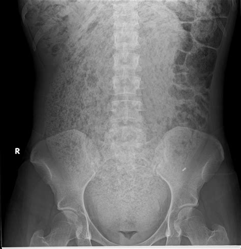 X Ray Of Severe Constipation
