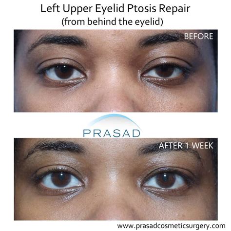 Left Eyelid Drooping A Primer On Ptosis