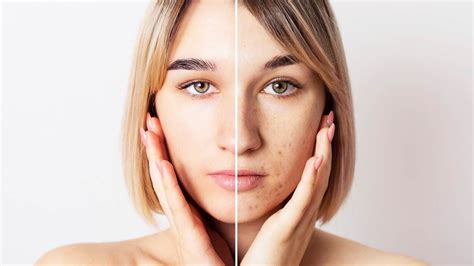 नारियल तेल से मुंहासों के निशान कैसे हटाएं | How To Remove Acne Scars ...