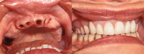 Image result for Immediate Dentures Procedure