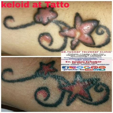 Keloid Scar Tattoos