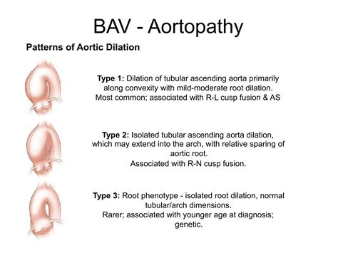 Bicuspid aortic valve | PPTX