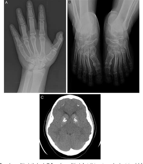 Pseudohypoparathyroidism Radiology