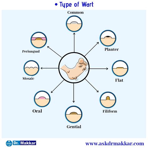 Warts Homeopathy ||Skin tag || Plantar wart || genital warts || foot corn || Causes || Symptom ...