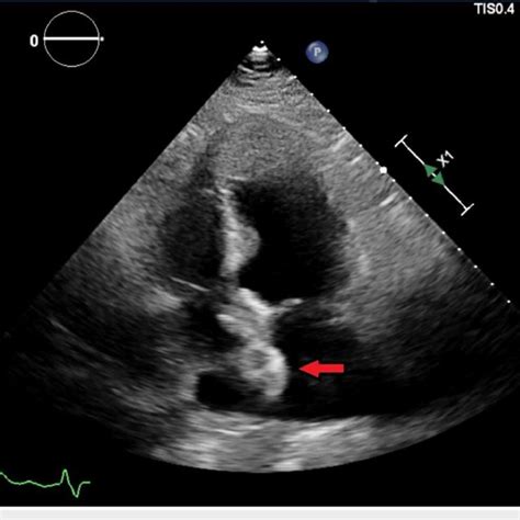 PFO Defect 的图像结果