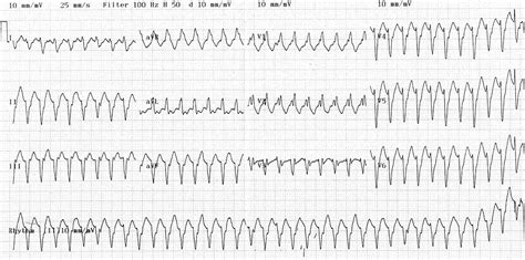 Cardiac Arrest. Shockable and Non-Shockable Rhythms