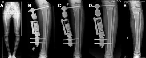 Medial Gradual Opening Osteotomy of the Tibia With Monolateral External Fixator for Correcting ...