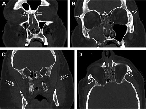 Imaging of Maxillofacial Injuries - Dental Clinics