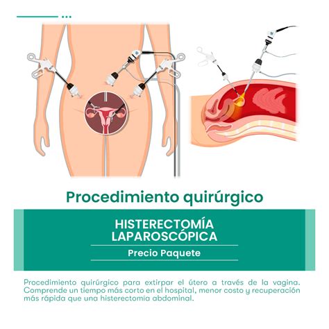 Histerectomia Vaginal Histerectomia (Retirada Do Útero) Dra. Maria