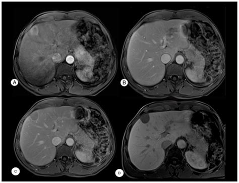 Hepatic Focal Lesion Suspicious for Hepatocellular Carcinoma in a ...