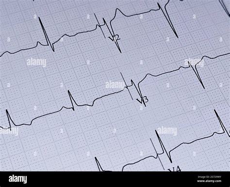 ECG ElectroCardioGraph paper that shows inferolateral T wave changes ...