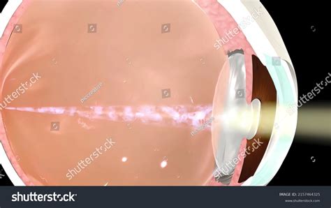 Image result for Sudden Vision Problems