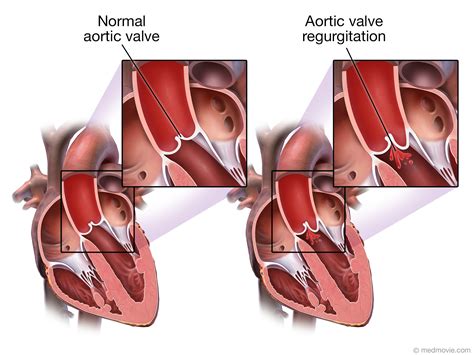Aortic Valve Regurgitation – Medmovie.com